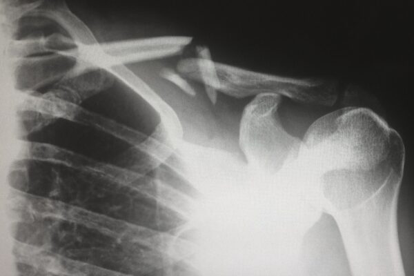 Radiographie de l'épaule